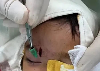 Đùa nghịch với bút bi, trẻ suýt gặp biến chứng vì dị vật hốc mắt