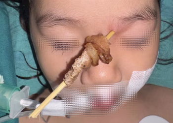 Bệnh viện Hữu nghị Việt Đức: Cứu thành công bé gái bị que xiên thịt cắm lên hốc mắt